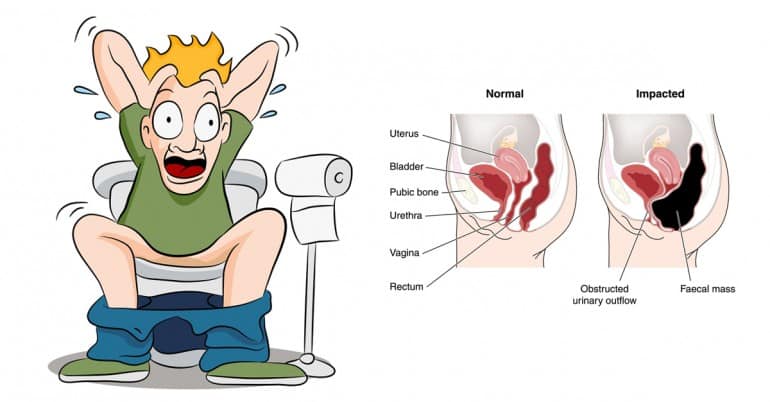 Constipation-Remedies-You-Should-Know-770x402.jpg