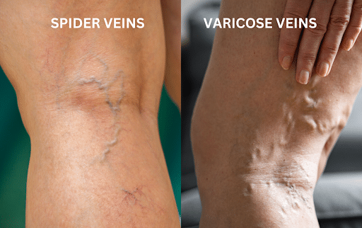 The Connection Between Varicose And Spider Veins Understanding The