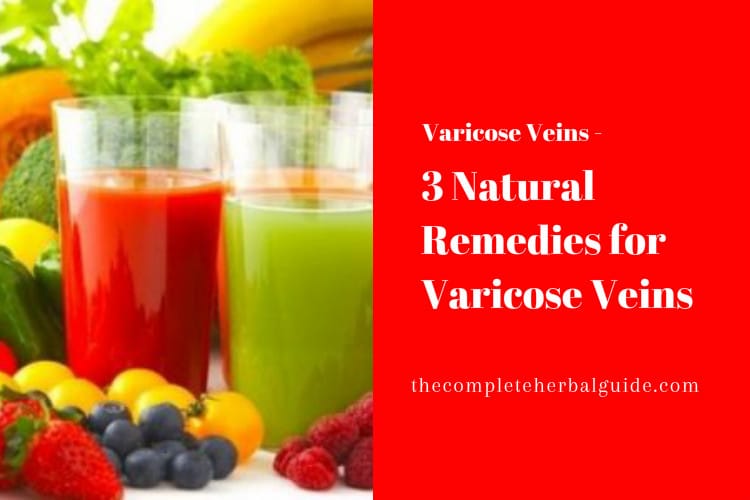 3 Natural Remedies for Varicose Veins