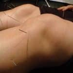 Knee-Acupuncture1-1