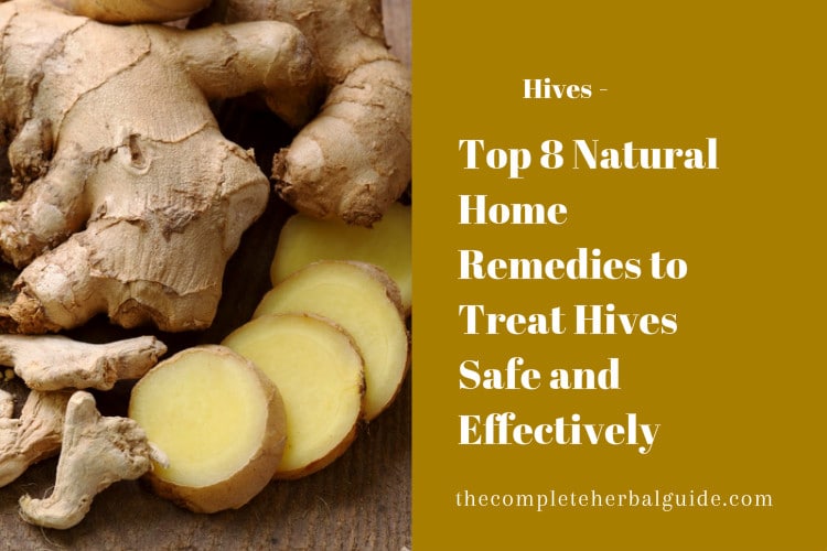 Top 8 Natural Home Remedies to Treat Hives Safe and Effectively