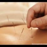 Ways Acupuncture Benefits Alzheimer Disease Patients