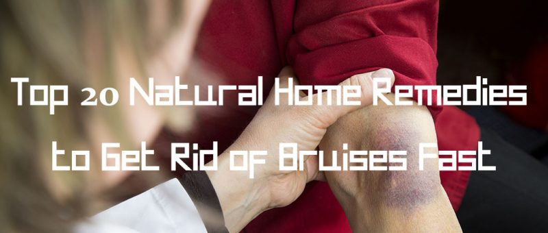 Top-20-Natural-Home-Remedies-to-Get-Rid-of-Bruises-Fast