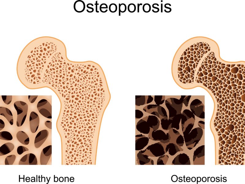 osteoporosis