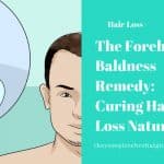 The Forehead Baldness Remedy: Curing Hair Loss Naturally
