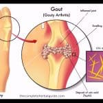 Natural Ayurvedic Home Remedies for Gout