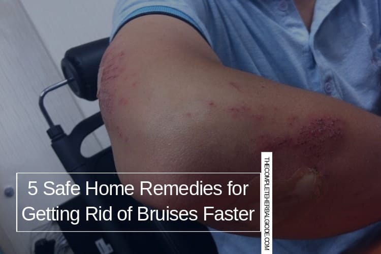 Top 20 Natural Home Remedies to Get Rid of Bruises Fast